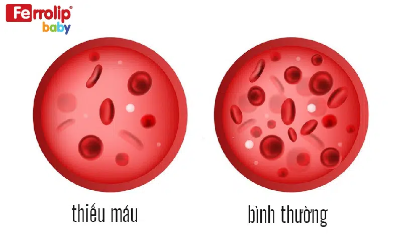 Trẻ thiếu máu thiếu sắt có số lượng hồng cầu giảm