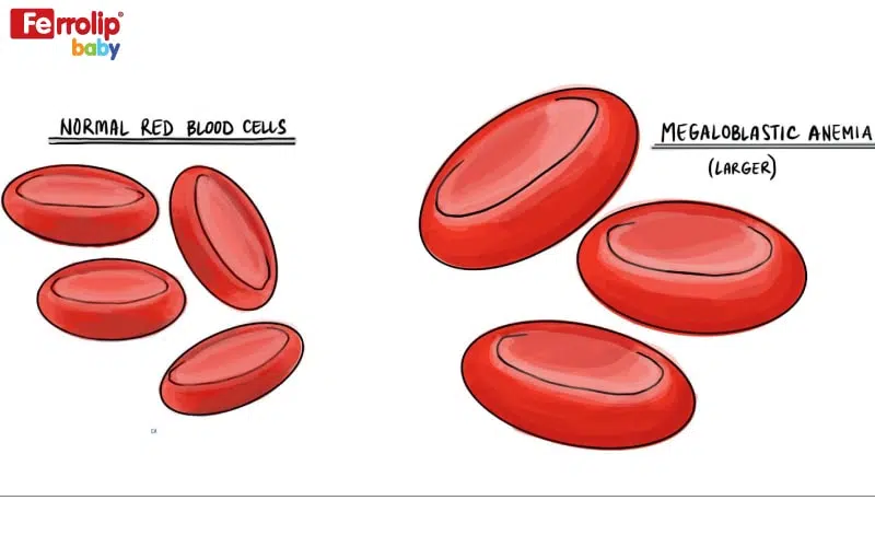 thiếu máu hồng cầu to ở trẻ