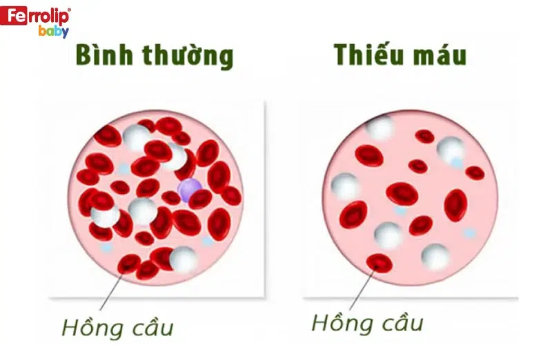 trẻ thiếu máu do thiếu sắt