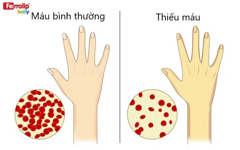 xét nghiệm máu cho bé